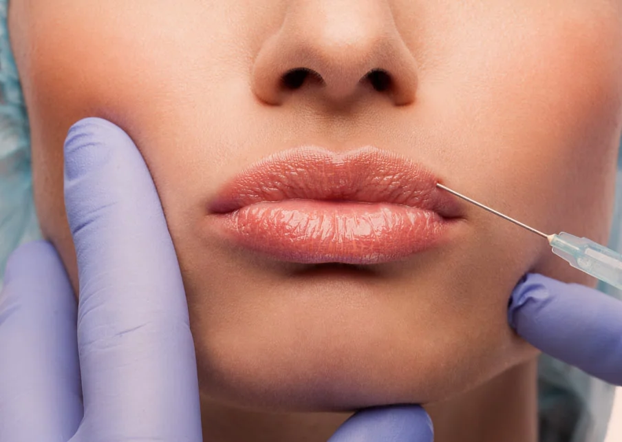 Подготовка к процедуре - Neuramis филлер для губ
