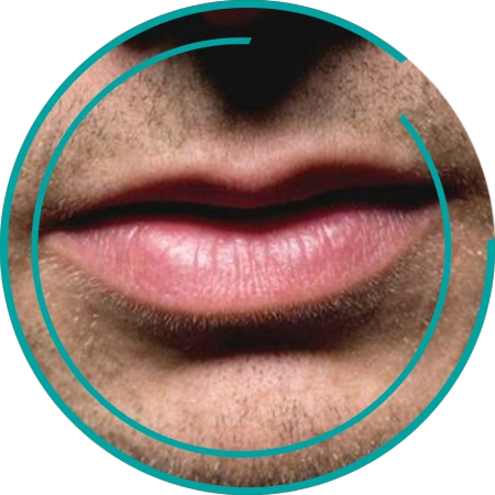 Увеличение губ мужчинам